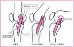 膝の内側側副靭帯（medial collateral ligament：MCL）の屈伸による影響
